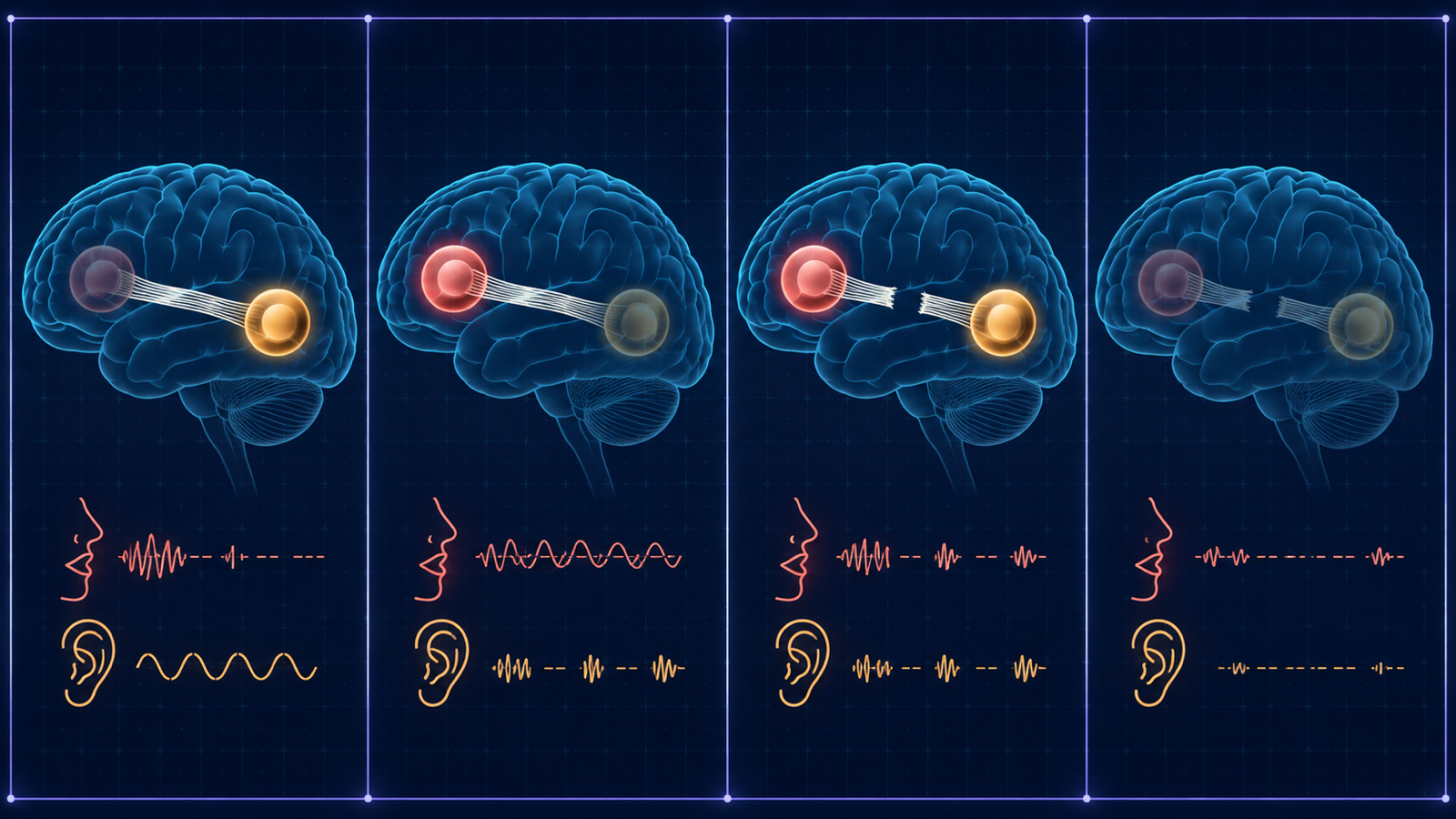Painel conceitual comparando padrões de redes de linguagem associados às principais síndromes afásicas.