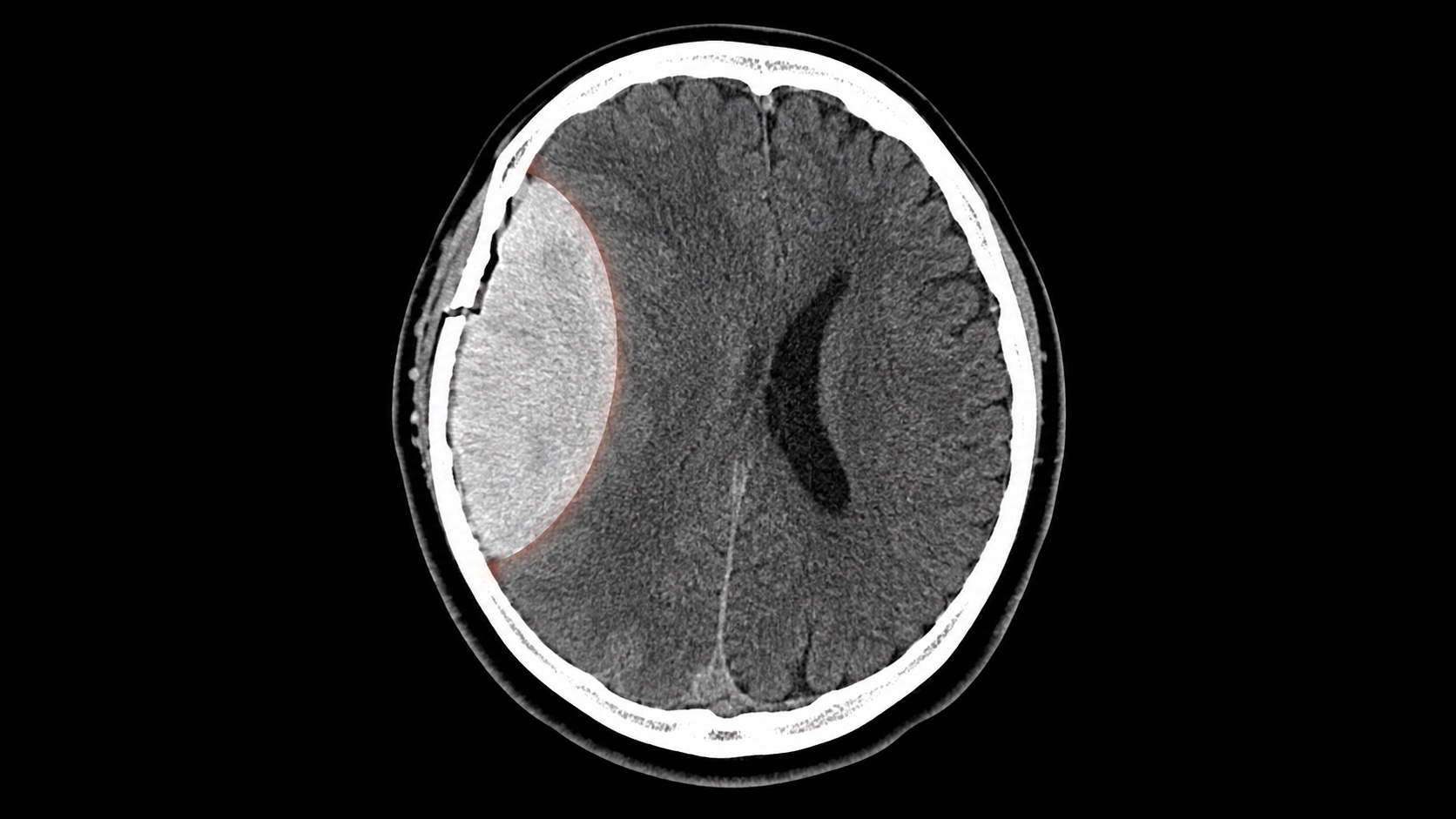 Ilustração sintética em estilo de TC axial sem contraste mostrando hematoma epidural agudo biconvexo com efeito de massa.