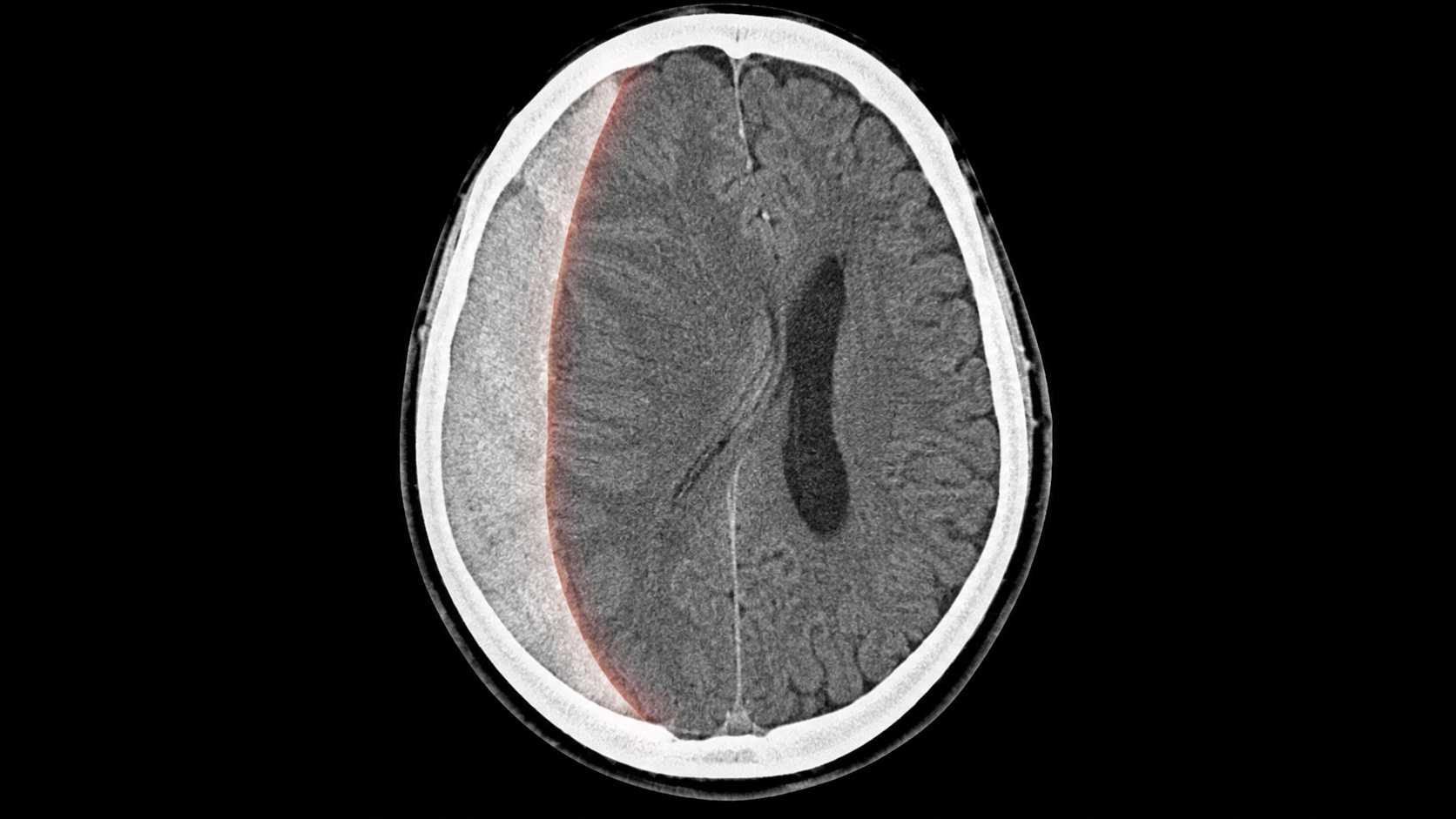 Ilustração sintética em estilo de TC axial sem contraste mostrando hematoma subdural agudo em crescente com desvio da linha média.