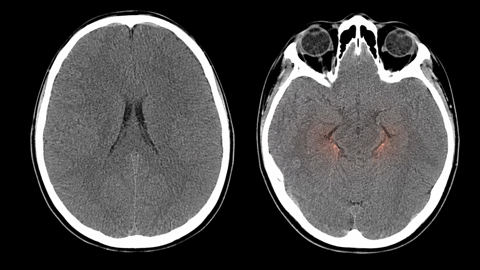 Ilustração sintética em estilo de TC axial sem contraste mostrando edema cerebral difuso, cisternas apagadas e sinais de herniação.