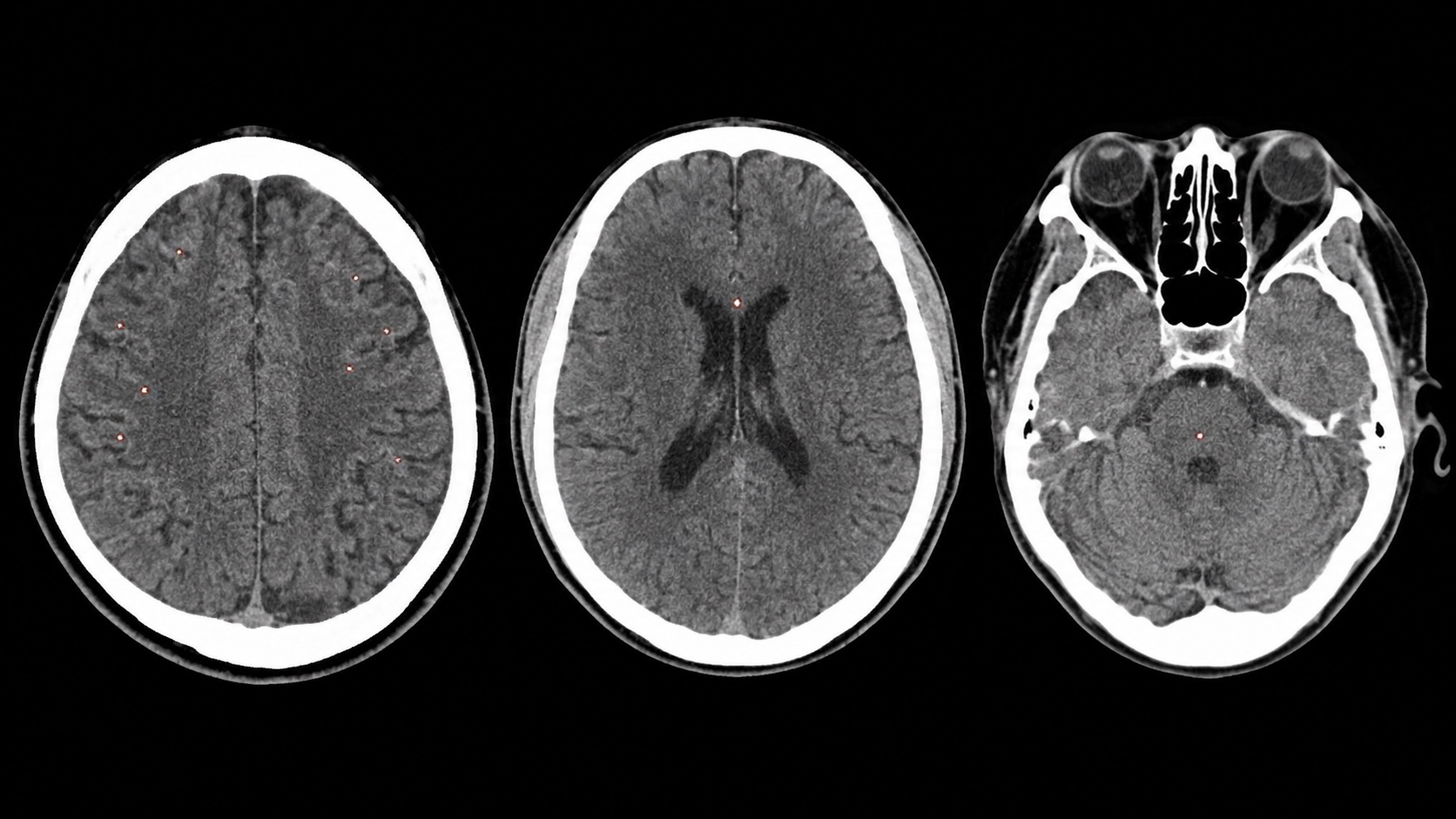 Ilustração sintética em estilo de TC axial sem contraste mostrando micro-hemorragias puntiformes compatíveis com lesão axonal difusa.