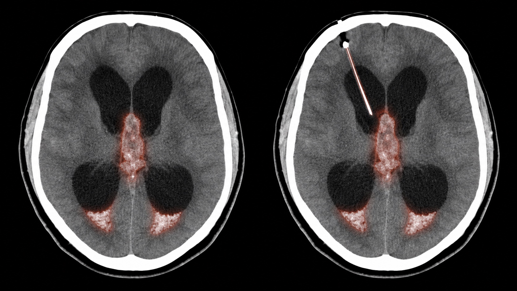 Ilustração sintética em estilo de TC axial sem contraste mostrando hemorragia intraventricular, hidrocefalia aguda e cateter ventricular externo.