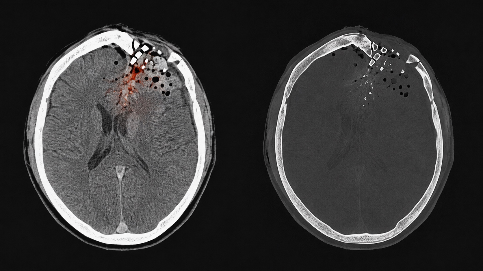 Ilustração sintética combinando janelas cerebral e óssea de fratura craniana aberta deprimida com trauma penetrante, pneumoencéfalo e contusão adjacente.