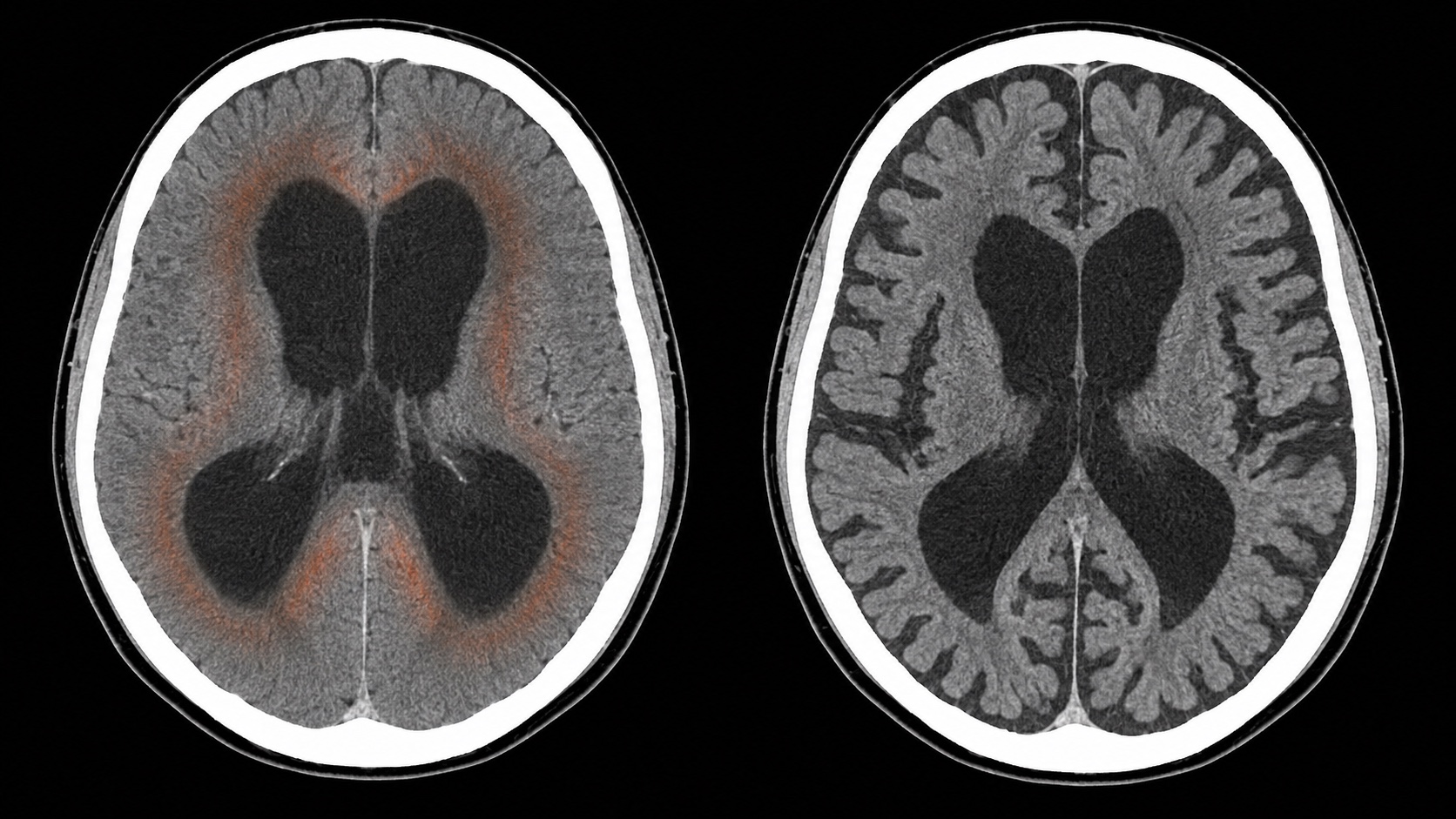 Ilustração sintética comparando hidrocefalia pós-traumática com ventriculomegalia ex vacuo em TC axial sem contraste.