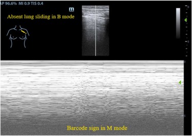 Figura clínica real de ultrassom pulmonar: modo B sem deslizamento pleural e modo M com padrão de linhas paralelas conhecido como sinal do código de barras.