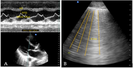 Figura clínica real em dois painéis: à esquerda, janela cardíaca paraesternal e modo M com EPSS; à direita, ultrassom pulmonar com múltiplas linhas B verticais.