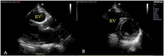 Figura clínica real em dois painéis ecocardiográficos: vistas paraesternal longitudinal e transversal com o ventrículo direito marcado e dilatado.