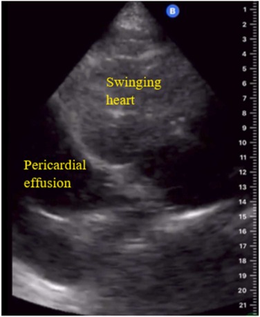 Figura clínica real de ecocardiografia com grande coleção anecoica pericárdica ao redor do coração e marcação de movimento pendular.