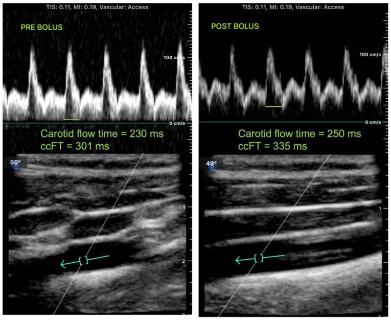 Figura clínica real em dois painéis com Doppler espectral da carótida antes e depois de bolus, mostrando tempo de fluxo carotídeo corrigido de 301 e 335 milissegundos.
