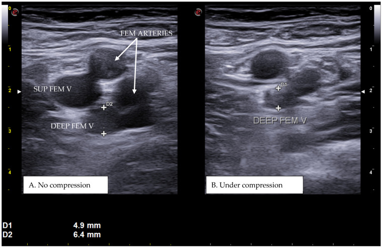 Figura clínica real em dois painéis da região femoral: sem compressão e sob compressão, com persistência do lúmen da veia femoral profunda trombosada.